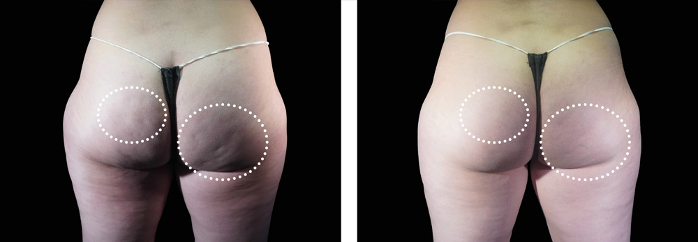 EMSculpt NEO Buttocks