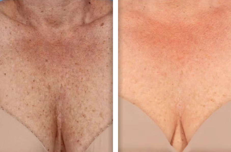 Pigmented Lesions Laser Treatment in Beverly Hills